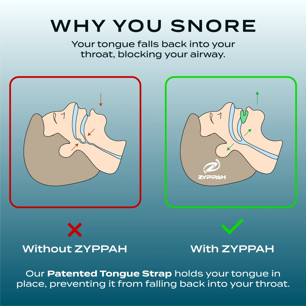 Anti Snoring Hybrid Oral Appliance Mouthguard S74806
