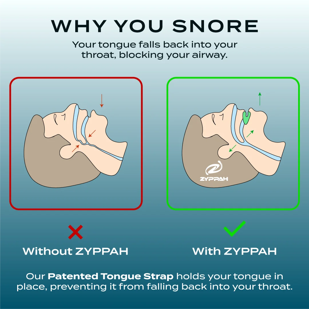Anti Snoring Hybrid Oral Appliance Mouthguard S74806